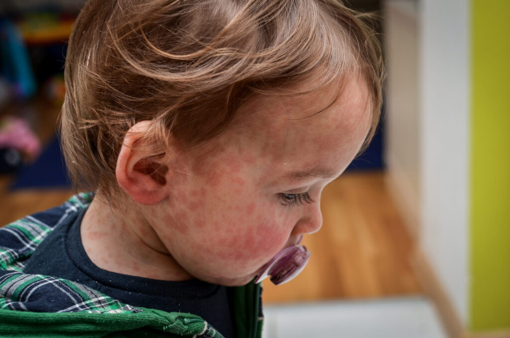 Child with soother in their mouth, with a measles outbreak rash